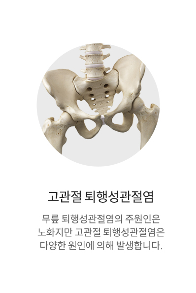 퇴행성관절염