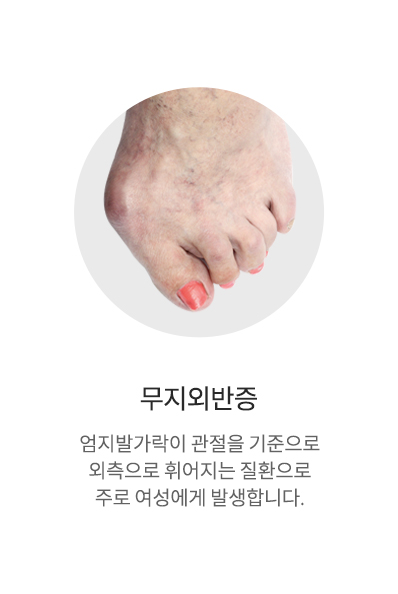 무지외반증