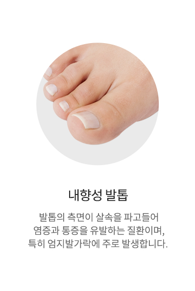 내성발톱