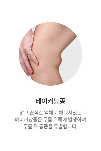 베이커낭종