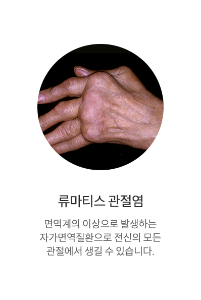 류마티스증후군
