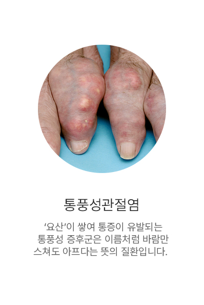 통풍성증후군
