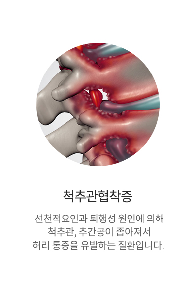 척추관협착증