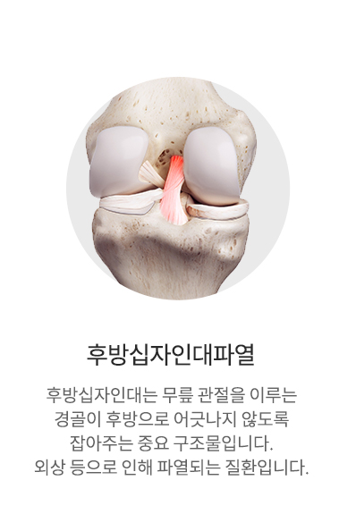 후방십자인대파열
