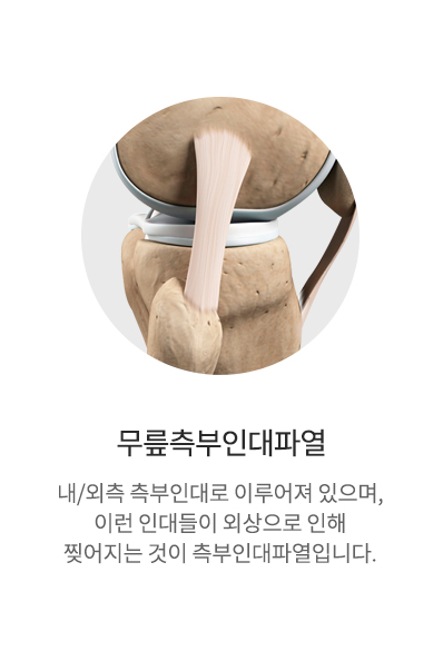 측부인대파열